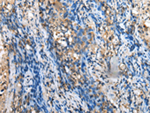 Immunohistochemistry of paraffin-embedded Human lung cancer tissue  using MOB4 Polyclonal Antibody at dilution of 1:35(×200)