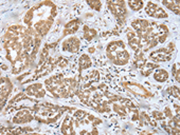 Immunohistochemistry of paraffin-embedded Human esophagus cancer tissue  using MOB4 Polyclonal Antibody at dilution of 1:35(×200)