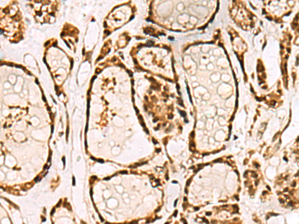 Immunohistochemistry of paraffin-embedded Human thyroid cancer tissue  using LRRC2 Polyclonal Antibody at dilution of 1:70(×200)