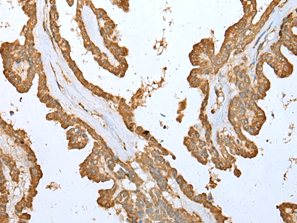 Immunohistochemistry of paraffin-embedded Human thyroid cancer tissue  using ALKBH8 Polyclonal Antibody at dilution of 1:25(×200)
