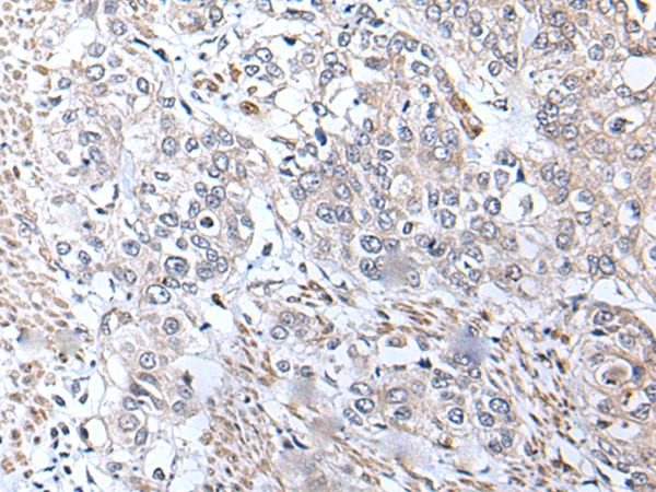 Immunohistochemistry of paraffin-embedded Human prost ate cancer tissue  using METTL7A Polyclonal Antibody at dilution of 1:40(×200)