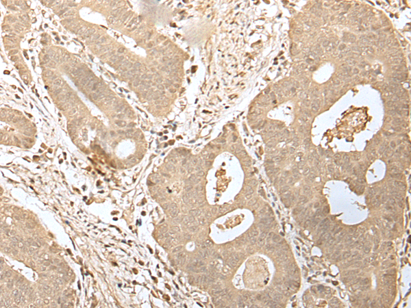 Immunohistochemistry of paraffin-embedded Human gastric cancer tissue  using HDHD2 Polyclonal Antibody at dilution of 1:40(×200)