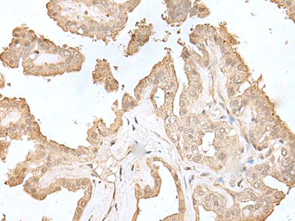 Immunohistochemistry of paraffin-embedded Human thyroid cancer tissue  using HDHD2 Polyclonal Antibody at dilution of 1:40(×200)