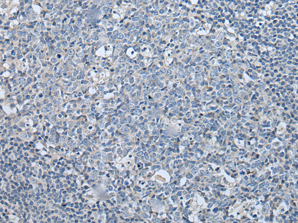 Immunohistochemistry of paraffin-embedded Human tonsil tissue  using LASP1 Polyclonal Antibody at dilution of 1:35(×200)