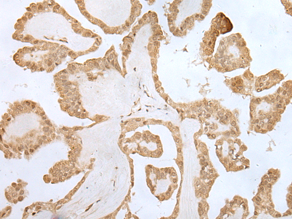 Immunohistochemistry of paraffin-embedded Human thyroid cancer tissue  using ZNF281 Polyclonal Antibody at dilution of 1:70(×200)