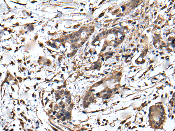Immunohistochemistry of paraffin-embedded Human gastric cancer tissue  using ZFP36 Polyclonal Antibody at dilution of 1:55(×200)