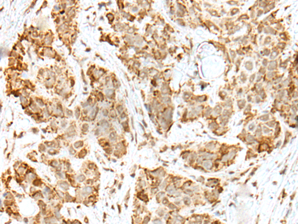 Immunohistochemistry of paraffin-embedded Human thyroid cancer tissue  using ZKSCAN1 Polyclonal Antibody at dilution of 1:30(×200)