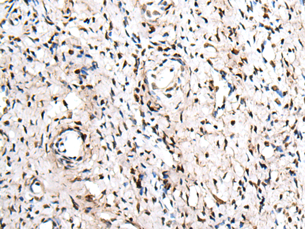 Immunohistochemistry of paraffin-embedded Human cervical cancer tissue  using ZNF207 Polyclonal Antibody at dilution of 1:30(×200)