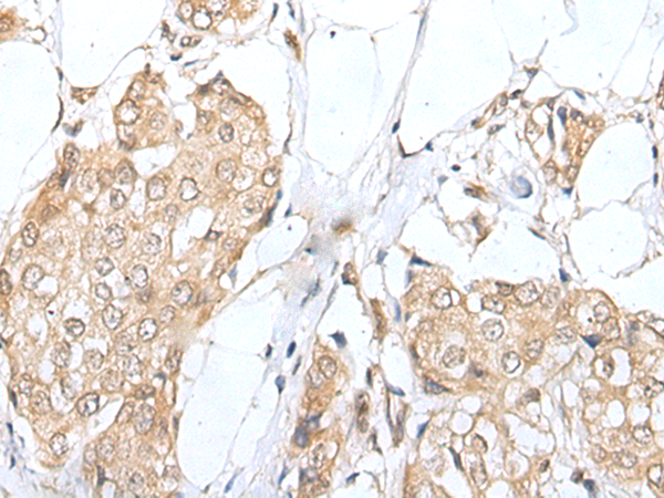 Immunohistochemistry of paraffin-embedded Human breast cancer tissue  using ZNF263 Polyclonal Antibody at dilution of 1:40(×200)