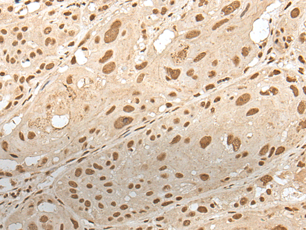 Immunohistochemistry of paraffin-embedded Human esophagus cancer tissue  using ZNF274 Polyclonal Antibody at dilution of 1:35(×200)