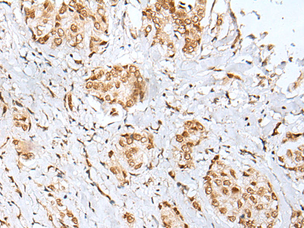 Immunohistochemistry of paraffin-embedded Human breast cancer tissue  using ZNF354A Polyclonal Antibody at dilution of 1:40(×200)