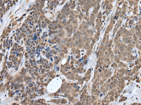 Immunohistochemistry of paraffin-embedded Human thyroid cancer tissue  using ZNF410 Polyclonal Antibody at dilution of 1:40(×200)