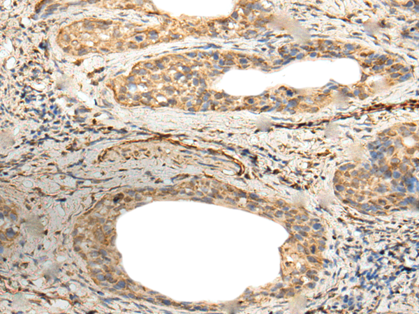 Immunohistochemistry of paraffin-embedded Human cervical cancer tissue  using ZNF8 Polyclonal Antibody at dilution of 1:40(×200)