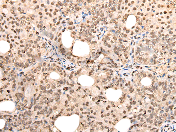 Immunohistochemistry of paraffin-embedded Human ovarian cancer tissue  using ZSCAN12 Polyclonal Antibody at dilution of 1:40(×200)