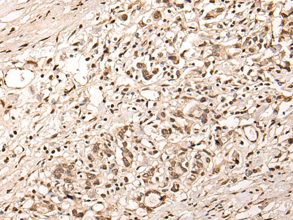 Immunohistochemistry of paraffin-embedded Human gastric cancer tissue  using ZSCAN12 Polyclonal Antibody at dilution of 1:40(×200)