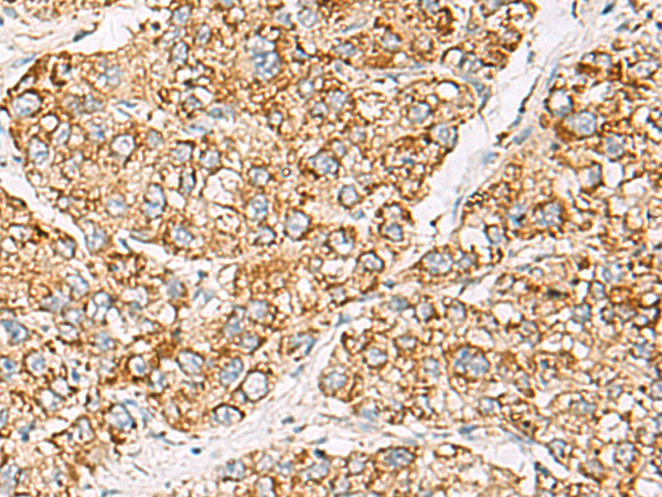 Immunohistochemistry of paraffin-embedded Human liver cancer tissue  using ZPBP2 Polyclonal Antibody at dilution of 1:50(×200)