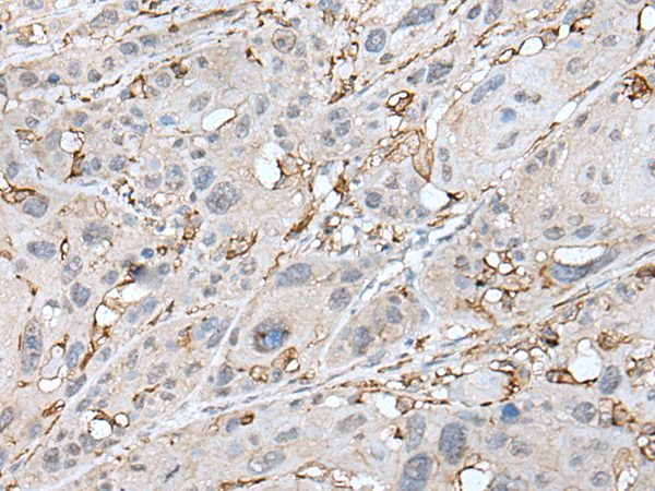Immunohistochemistry of paraffin-embedded Human esophagus cancer tissue  using CD14 Polyclonal Antibody at dilution of 1:40(×200)