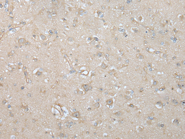 Immunohistochemistry of paraffin-embedded Human brain tissue  using VILL Polyclonal Antibody at dilution of 1:65(×200)