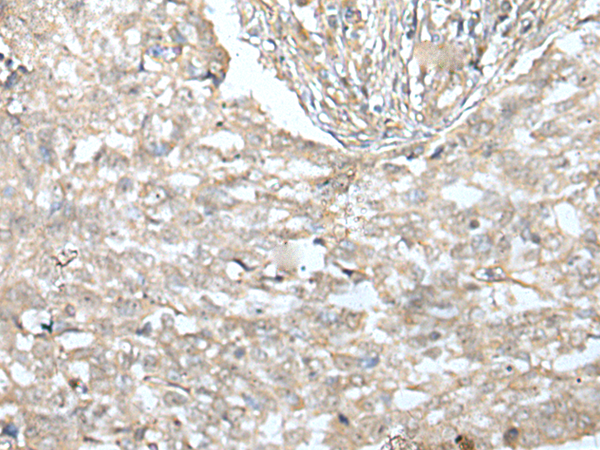 Immunohistochemistry of paraffin-embedded Human lung cancer tissue  using VILL Polyclonal Antibody at dilution of 1:65(×200)