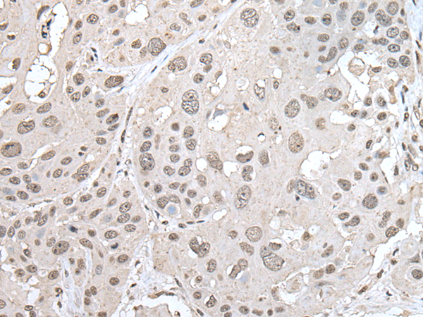 Immunohistochemistry of paraffin-embedded Human esophagus cancer tissue  using VRK1 Polyclonal Antibody at dilution of 1:30(×200)