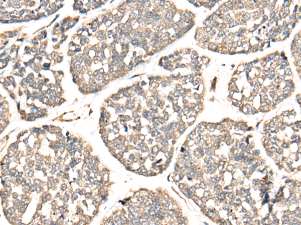 Immunohistochemistry of paraffin-embedded Human esophagus cancer tissue  using VTI1B Polyclonal Antibody at dilution of 1:30(×200)