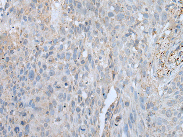 Immunohistochemistry of paraffin-embedded Human lung cancer tissue  using VWA2 Polyclonal Antibody at dilution of 1:45(×200)