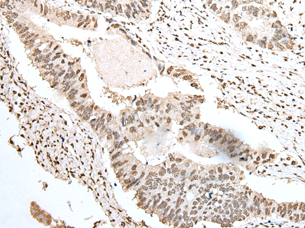 Immunohistochemistry of paraffin-embedded Human colorectal cancer tissue  using SNRPA Polyclonal Antibody at dilution of 1:55(×200)