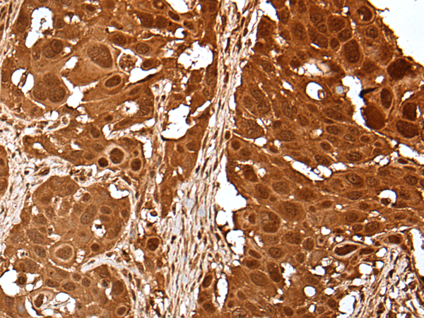 Immunohistochemistry of paraffin-embedded Human esophagus cancer tissue  using UBE2V1 Polyclonal Antibody at dilution of 1:40(×200)