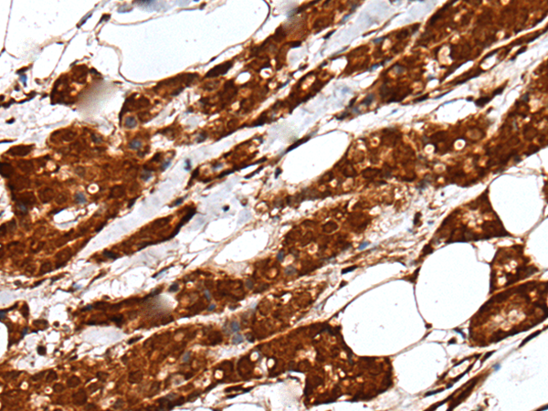 Immunohistochemistry of paraffin-embedded Human breast cancer tissue  using UBE2V1 Polyclonal Antibody at dilution of 1:40(×200)