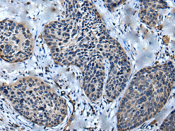 Immunohistochemistry of paraffin-embedded Human cervical cancer tissue  using ULK4 Polyclonal Antibody at dilution of 1:75(×200)