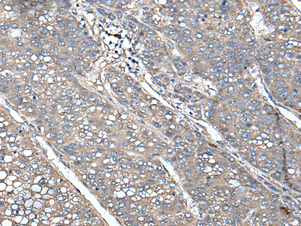 Immunohistochemistry of paraffin-embedded Human liver cancer tissue  using UNC13B Polyclonal Antibody at dilution of 1:85(×200)
