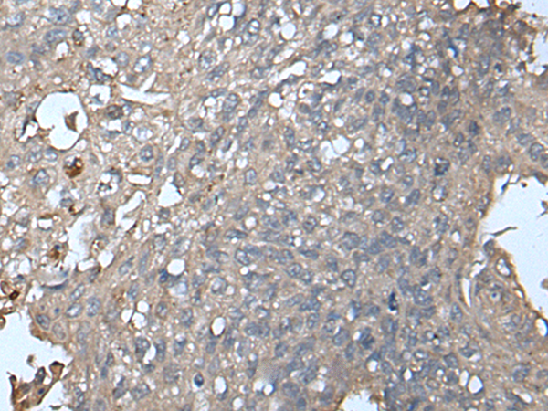 Immunohistochemistry of paraffin-embedded Human lung cancer tissue  using UNC13B Polyclonal Antibody at dilution of 1:85(×200)