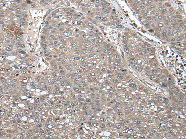 Immunohistochemistry of paraffin-embedded Human liver cancer tissue  using UNC45B Polyclonal Antibody at dilution of 1:65(×200)