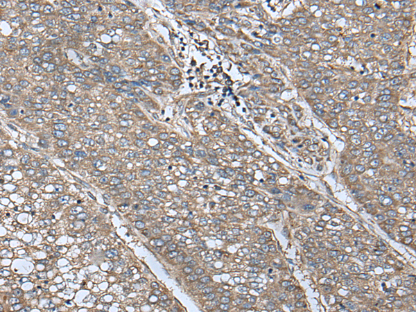 Immunohistochemistry of paraffin-embedded Human liver cancer tissue  using UQCRQ Polyclonal Antibody at dilution of 1:50(×200)