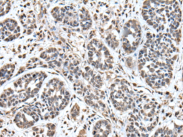 Immunohistochemistry of paraffin-embedded Human esophagus cancer tissue  using UPK3A Polyclonal Antibody at dilution of 1:55(×200)