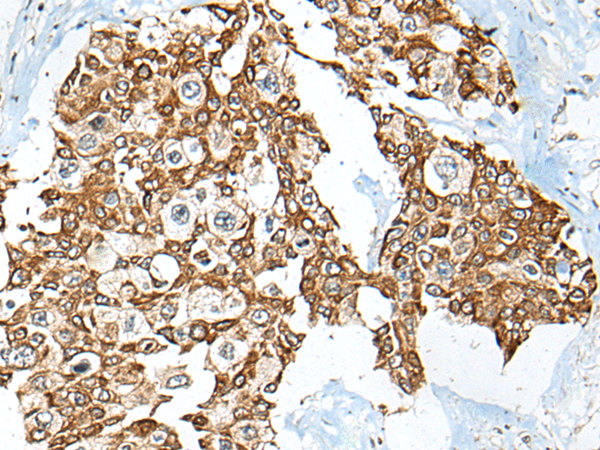 Immunohistochemistry of paraffin-embedded Human prost ate cancer tissue  using USP12 Polyclonal Antibody at dilution of 1:35(×200)