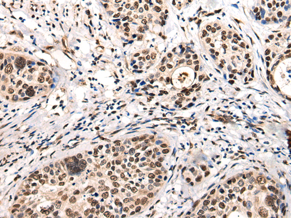 Immunohistochemistry of paraffin-embedded Human cervical cancer tissue  using USP6NL Polyclonal Antibody at dilution of 1:30(×200)