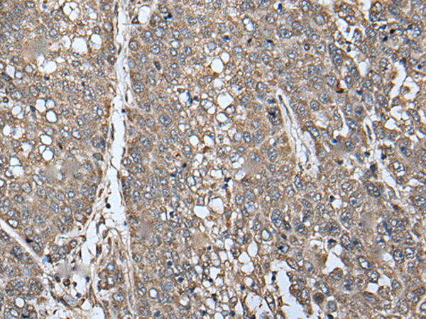 Immunohistochemistry of paraffin-embedded Human liver cancer tissue  using ATAD1 Polyclonal Antibody at dilution of 1:65(×200)