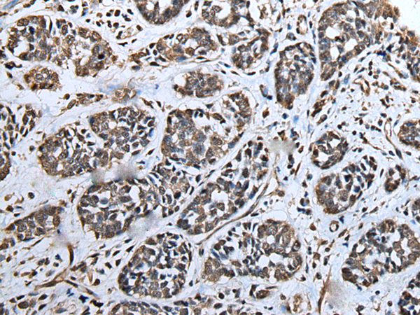 Immunohistochemistry of paraffin-embedded Human esophagus cancer tissue  using ATAD1 Polyclonal Antibody at dilution of 1:65(×200)