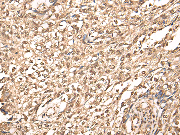 Immunohistochemistry of paraffin-embedded Human lung cancer tissue  using ATAD3A Polyclonal Antibody at dilution of 1:30(×200)