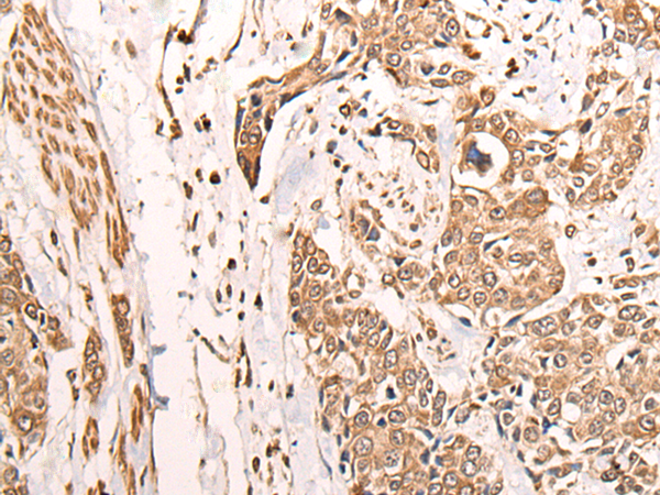 Immunohistochemistry of paraffin-embedded Human prost ate cancer tissue  using ATAD3A Polyclonal Antibody at dilution of 1:30(×200)