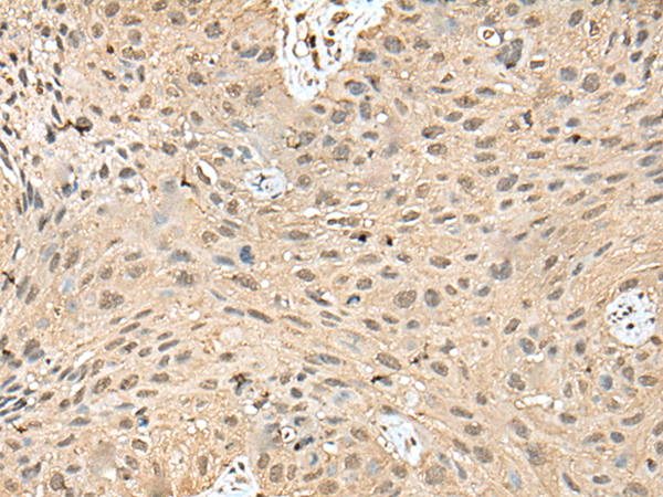 Immunohistochemistry of paraffin-embedded Human lung cancer tissue  using ATXN3 Polyclonal Antibody at dilution of 1:50(×200)