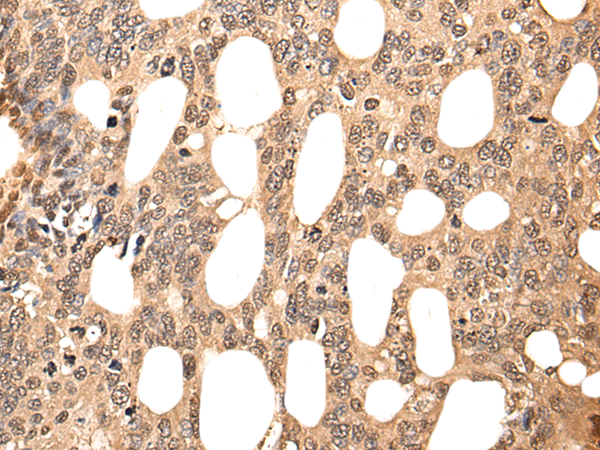 Immunohistochemistry of paraffin-embedded Human colorectal cancer tissue  using ATF7 Polyclonal Antibody at dilution of 1:40(×200)