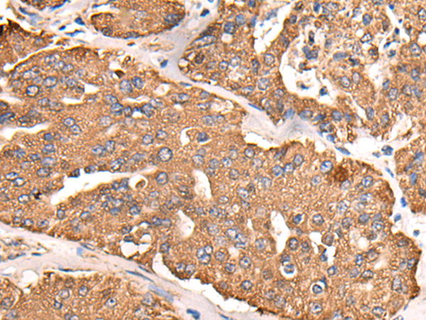 Immunohistochemistry of paraffin-embedded Human liver cancer tissue  using ATP5C1 Polyclonal Antibody at dilution of 1:55(×200)