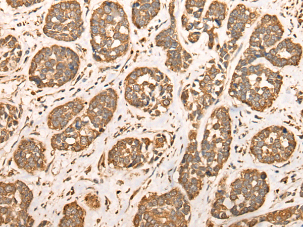 Immunohistochemistry of paraffin-embedded Human esophagus cancer tissue  using BAIAP2L1 Polyclonal Antibody at dilution of 1:30(×200)