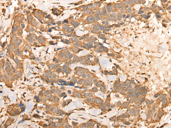 Immunohistochemistry of paraffin-embedded Human thyroid cancer tissue  using BAIAP2L1 Polyclonal Antibody at dilution of 1:30(×200)