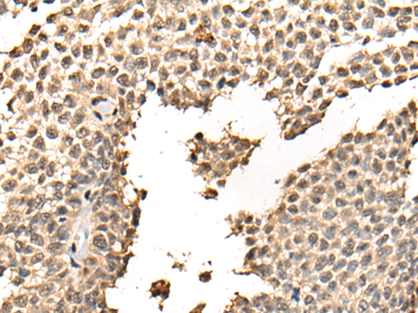 Immunohistochemistry of paraffin-embedded Human ovarian cancer tissue  using BATF Polyclonal Antibody at dilution of 1:40(×200)