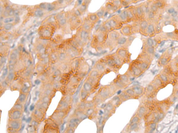 Immunohistochemistry of paraffin-embedded Human thyroid cancer tissue  using BBOX1 Polyclonal Antibody at dilution of 1:50(×200)