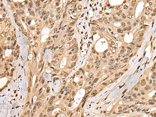 Immunohistochemistry of paraffin-embedded Human colorectal cancer tissue  using PHF21A Polyclonal Antibody at dilution of 1:50(×200)