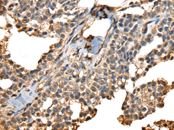 Immunohistochemistry of paraffin-embedded Human ovarian cancer tissue  using PHF21A Polyclonal Antibody at dilution of 1:50(×200)